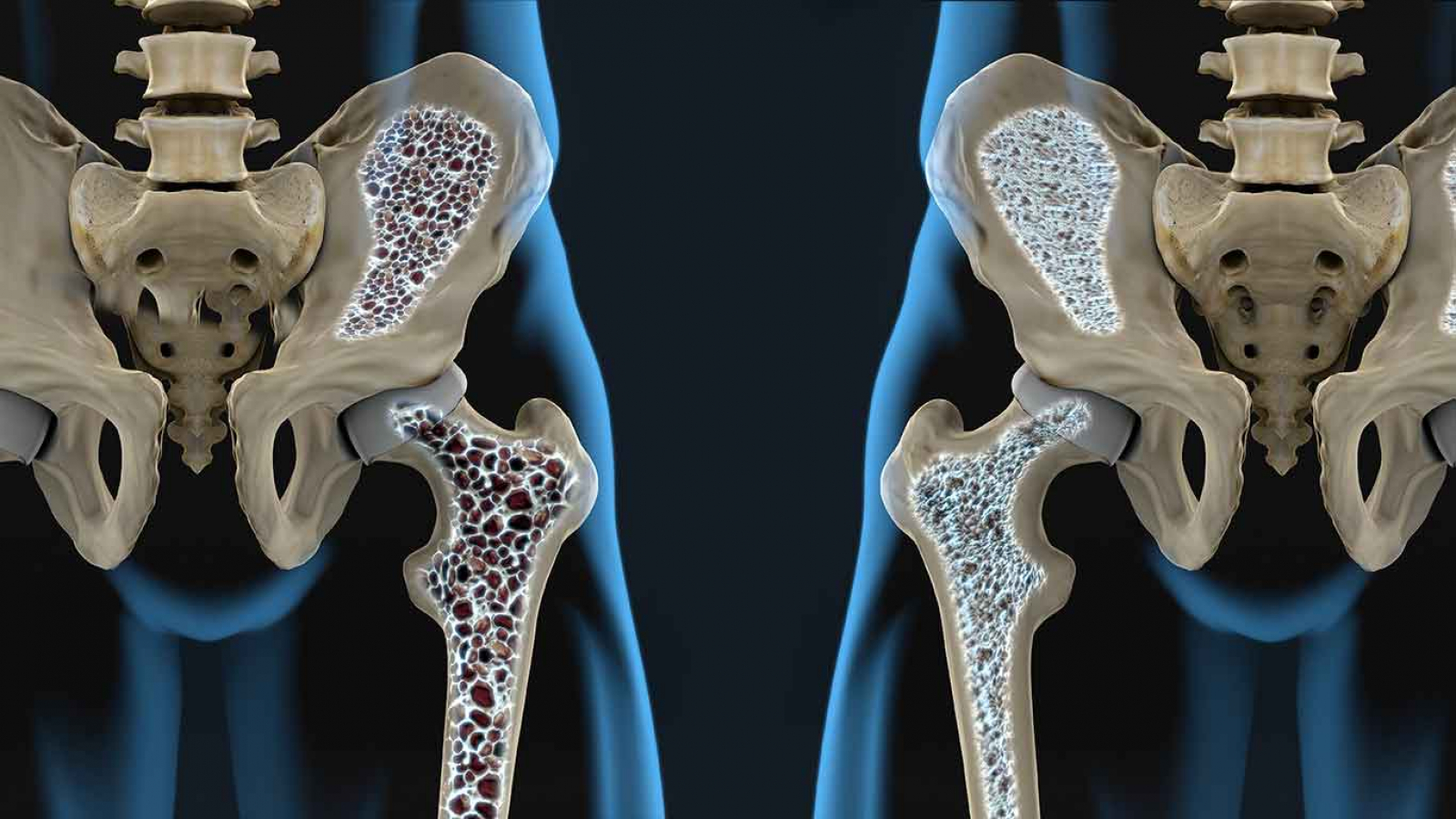 Azentex e Osteoporose: Como o Medicamento Auxilia na Prevenção de Fraturas Ósseas