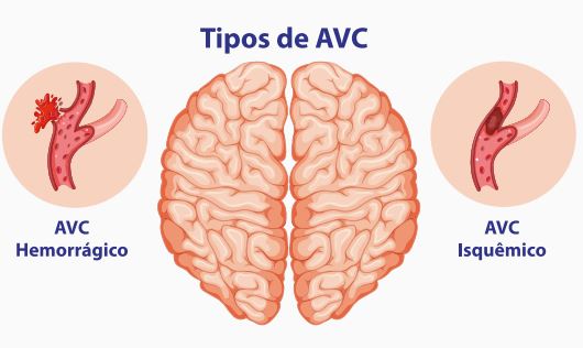 Quando a dor de Cabeça é um sinal de Alerta?