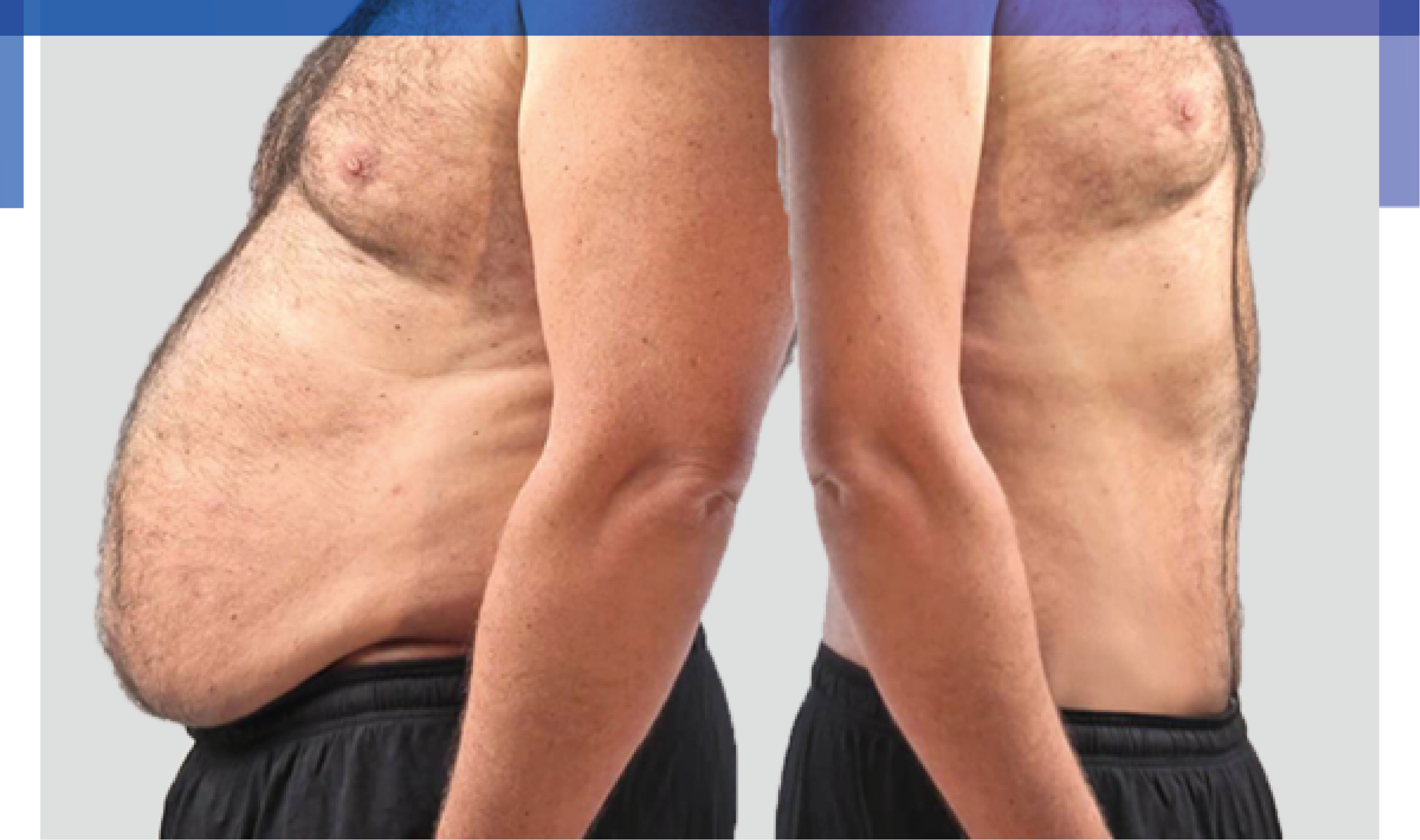 Pensando em fazer cirurgia bariátrica? Tudo sobre o procedimento, do pré ao pós