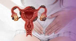 Endometriose Profunda: Tratamentos hormonais de última geração e controle da dor crônica