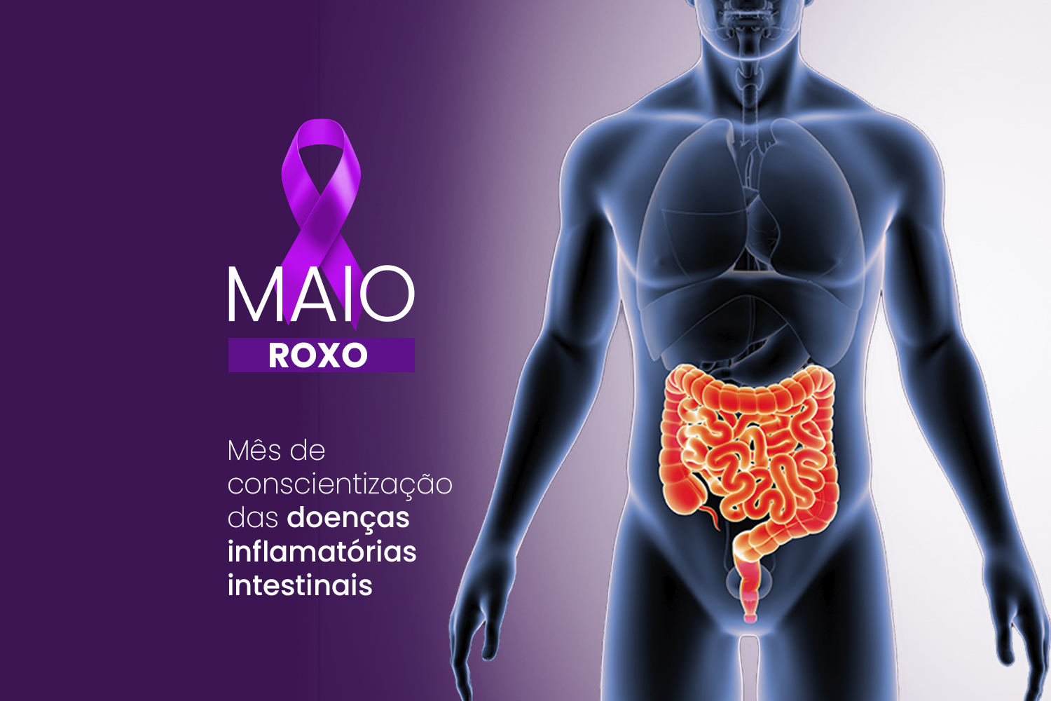 Maio Roxo: o avanço no tratamento da doença de Crohn e Retocolite Ulcerativa